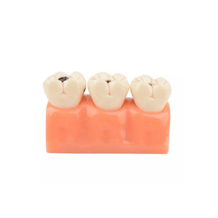 4x Enlarged Dental Caries Decomposition Tooth Model